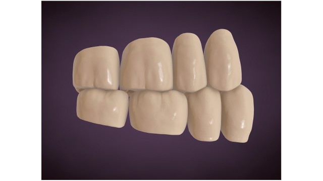 Occlusione dente - due denti Occlusione dente - due denti