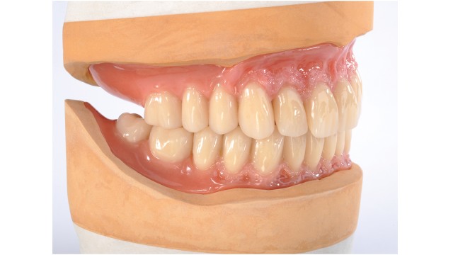 Modello con protesi realizzata con Pala Idealis Modello con protesi realizzata con Pala Idealis